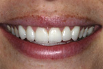 6 Porcelain Veneers